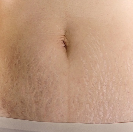 help with stretch marks.jpg