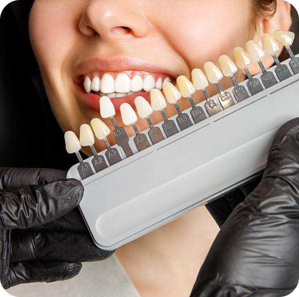 Shade-Matching-Tooth-Prep.webp